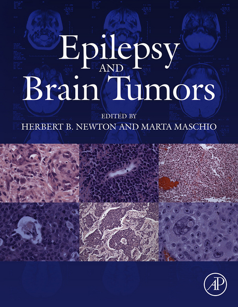 Epilepsy and Brain Tumors - 