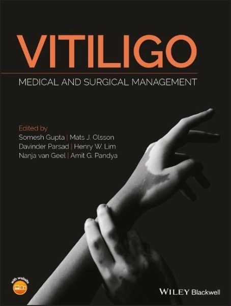 Vitiligo - 