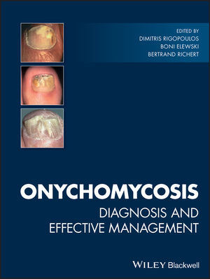 Onychomycosis - 