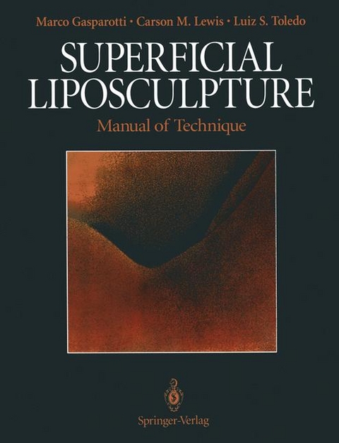 Superficial Liposculpture - Marco Gasparotti, Carson M. Lewis, Luiz S. Toledo