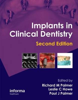 Implants in Clinical Dentistry -  Leslie C. Howe,  Paul J. Palmer,  Richard M. Palmer