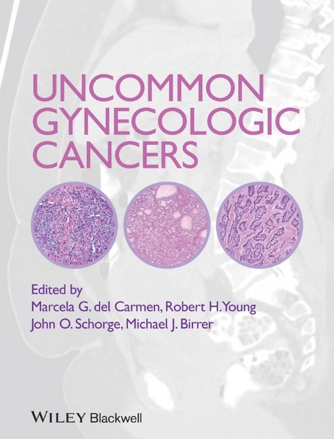 Uncommon Gynecologic Cancers - 