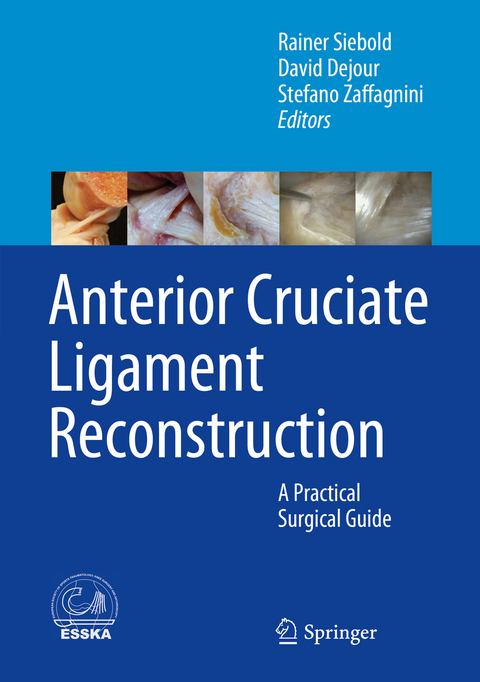 Anterior Cruciate Ligament Reconstruction - 