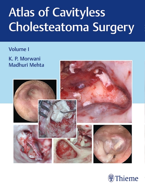 Atlas of Cavityless Cholesteatoma Surgery, Vol 1 - K Morwani, Madhuri Mehta