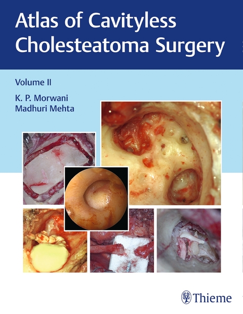 Atlas of Cavityless Cholesteatoma Surgery, Vol 2 - K Morwani, Madhuri Mehta
