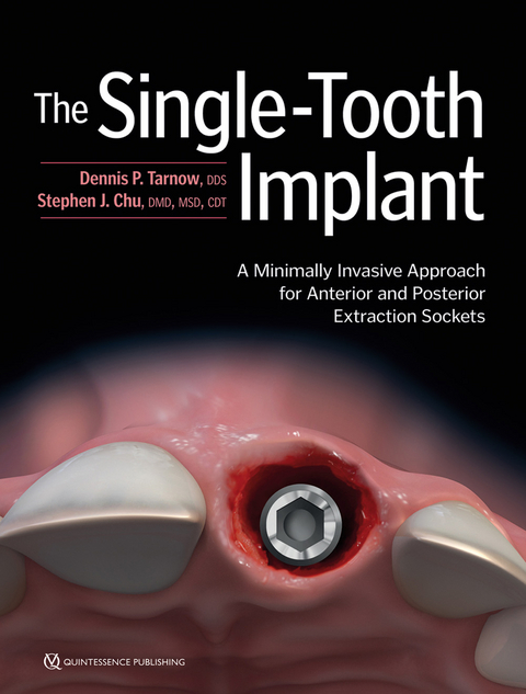 The Single-Tooth Implant - Dennis P Tarnow