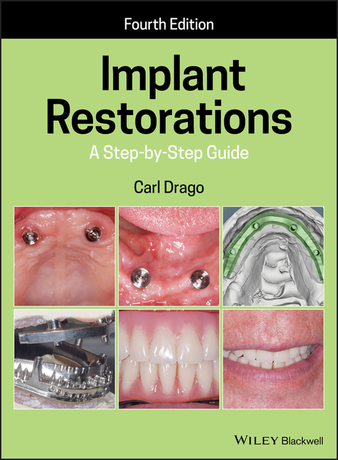 Implant Restorations - Carl Drago