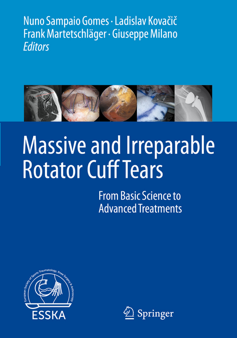 Massive and Irreparable Rotator Cuff Tears - 