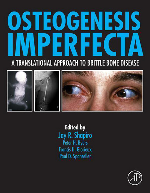 Osteogenesis Imperfecta - 