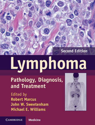 Lymphoma - 