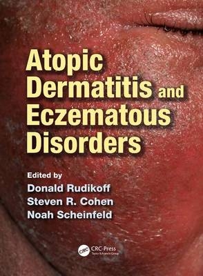 Atopic Dermatitis and Eczematous Disorders - 