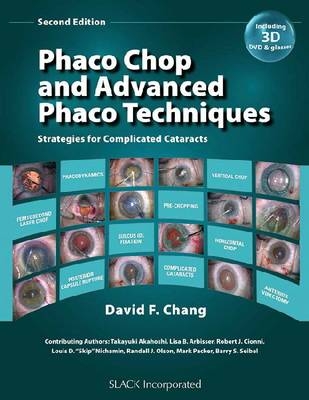 Phaco Chop and Advanced Phaco Techniques - 