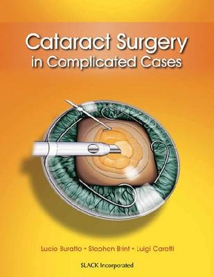 Cataract Surgery in Complicated Cases - 