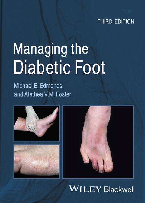 Managing the Diabetic Foot -  Michael E. Edmonds,  Alethea V. M. Foster