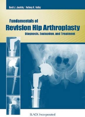 Fundamentals of Revision Hip Arthroplasty - 