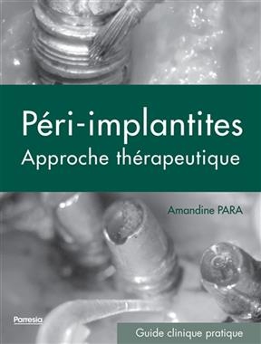 Péri-implantites : approche thérapeutique - Amandine Para