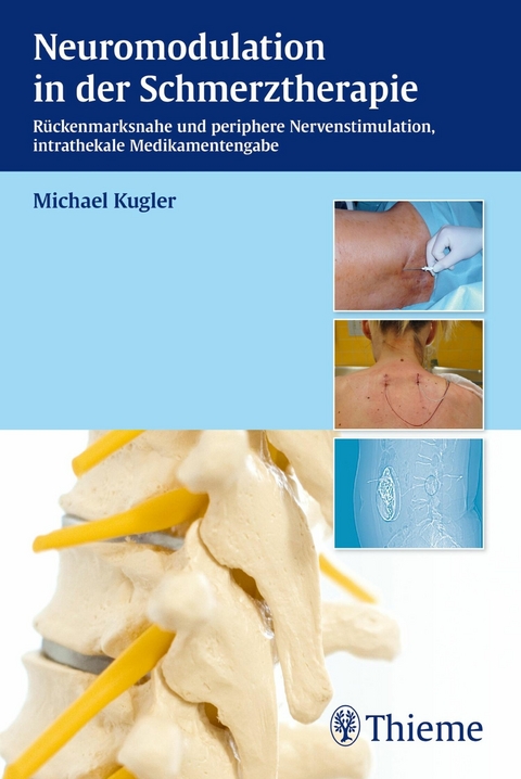 Neuromodulation in der Schmerztherapie - Michael Kugler