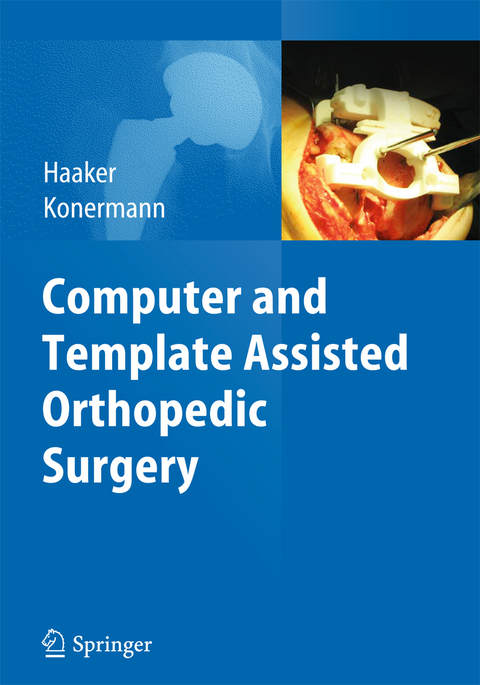 Computer and Template Assisted Orthopedic Surgery - 