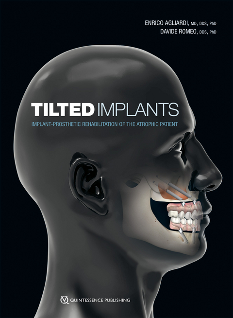 Tilted Implants - Enrico Agliardi