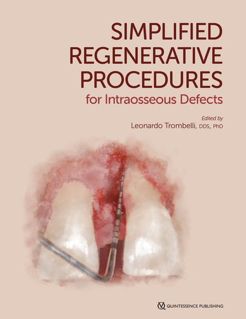 Simplified Regenerative Procedures for Intraosseous Defects -  Trombell Leonardo Ed