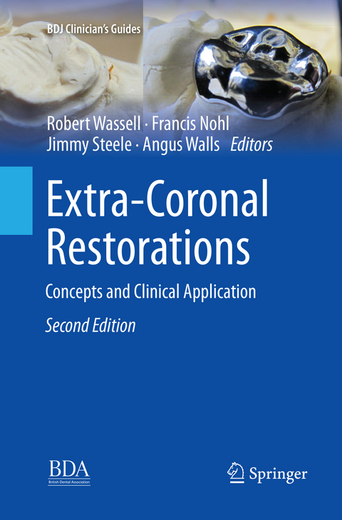 Extra-Coronal Restorations - 
