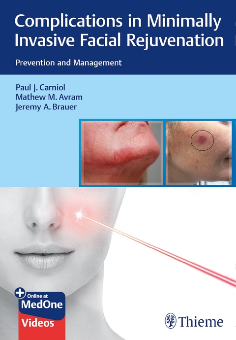 Complications in Minimally Invasive Facial Rejuvenation - Paul J. Carniol, Mathew M. Avram, Jeremy A. Brauer