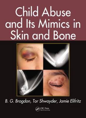 Child Abuse and its Mimics in Skin and Bone - Mobile B. G. (University of South Alabama  USA) Brogdon, Albuquerque Jamie (University of New Mexico  USA) Elifritz, Detroit Tor (Henry Ford Hospital  Michigan  USA) Shwayder
