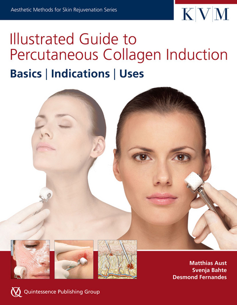 Illustrated Guide to Percutaneous Collagen Induction: Basics, Indications, Uses - Matthias Aust, Svenja Bahte, Desmond Fernandes