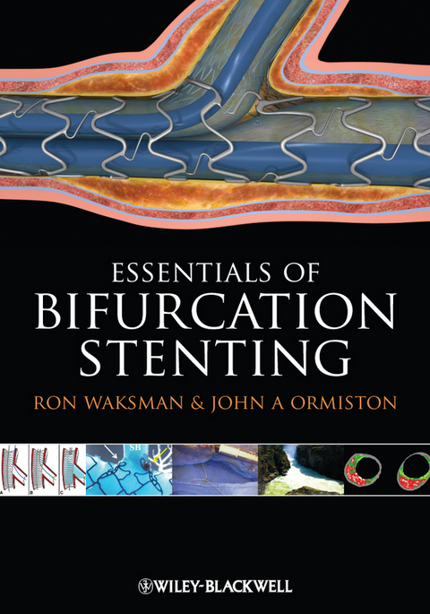 Bifurcation Stenting -  John A. Ormiston,  Ron Waksman