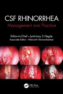 CSF Rhinorrhoea - 
