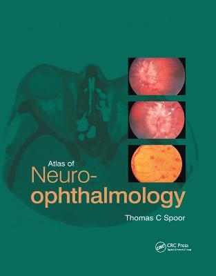 Atlas of Neuro-ophthalmology - Thomas C. Spoor