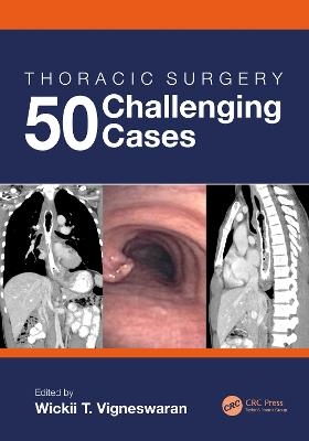 Thoracic Surgery: 50 Challenging cases - 