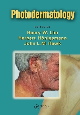 Photodermatology - 