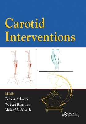 Carotid Interventions - 