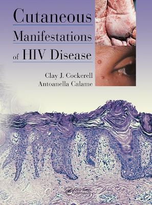 Cutaneous Manifestations of HIV Disease - Clay Cockerell, Antoanella Calame
