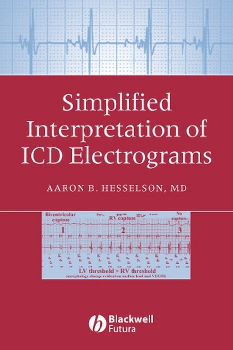 Simplified Interpretation of ICD Electrograms -  Aaron B. Hesselson