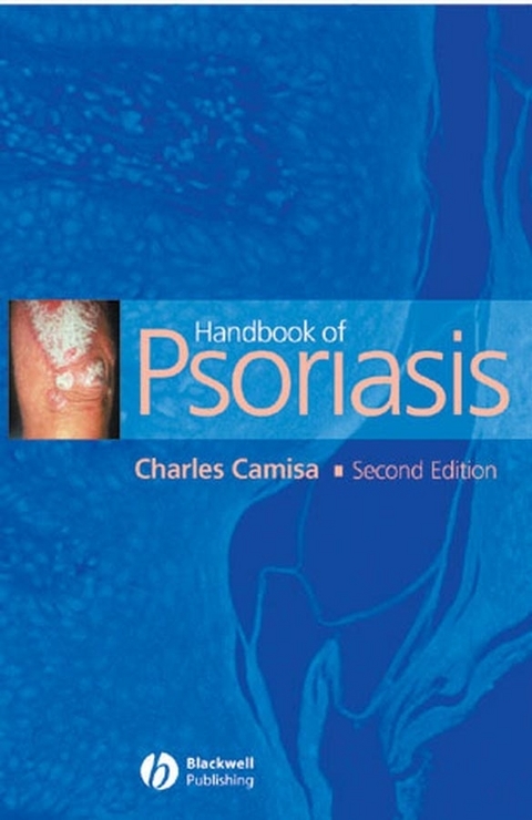 Handbook of Psoriasis -  Charles Camisa