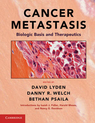 Cancer Metastasis - 