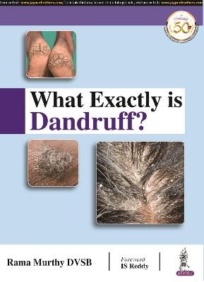 What Exactly is Dandruff? - Rama Murthy DVSB