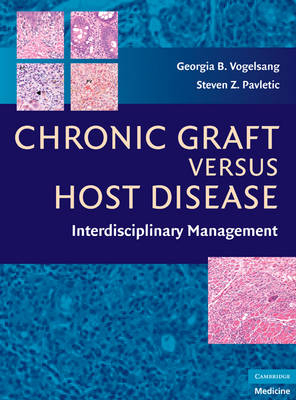 Chronic Graft Versus Host Disease - 