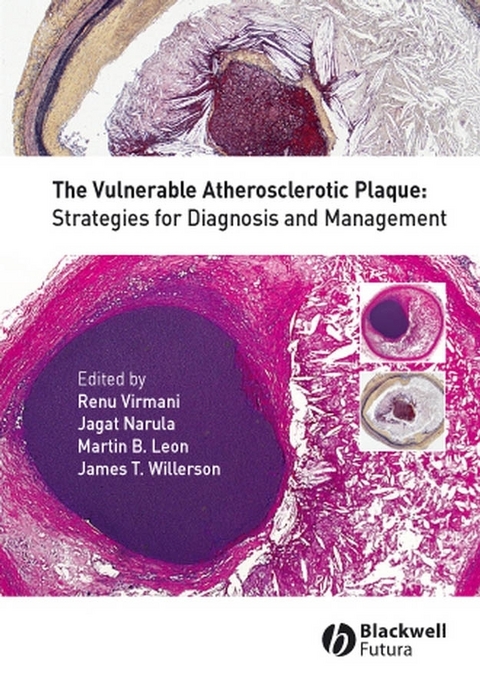 Vulnerable Atherosclerotic Plaque - 