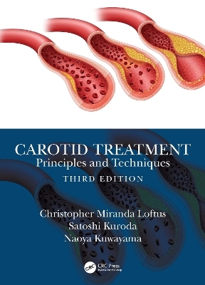 Carotid Treatment: Principles and Techniques - Christopher Miranda Loftus, Satoshi Kuroda, Naoya Kuwayama