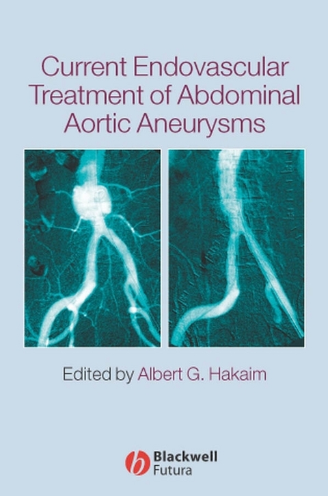 Current Endovascular Treatment of Abdominal Aortic Aneurysms - 