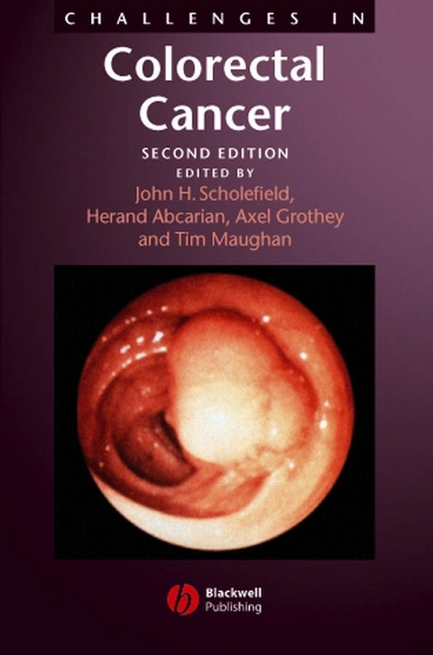 Challenges in Colorectal Cancer - 
