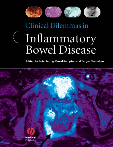 Clinical Dilemmas in Inflammatory Bowel Disease - 