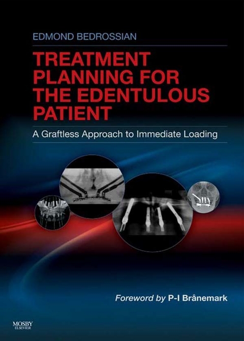 Implant Treatment Planning for the Edentulous Patient -  Edmond Bedrossian