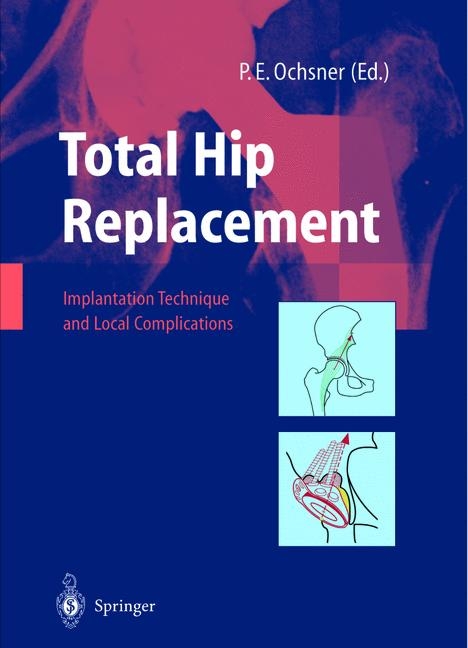 Hip Replacement -  Raj K. Sinha