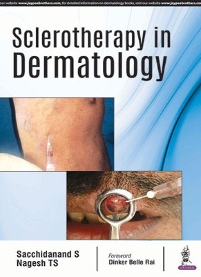 Sclerotherapy in Dermatology - Sacchidanand S, Nagesh TS