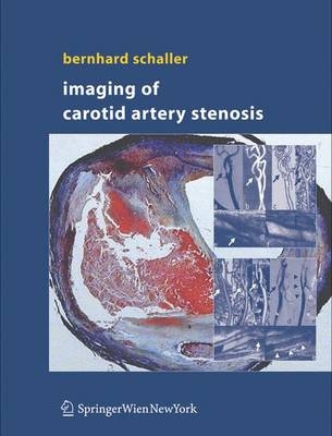 Carotid Artery Stenosis - 