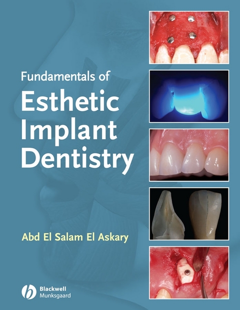 Fundamentals of Esthetic Implant Dentistry - Abdelsalam Elaskary